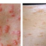 dog with scabies treatment