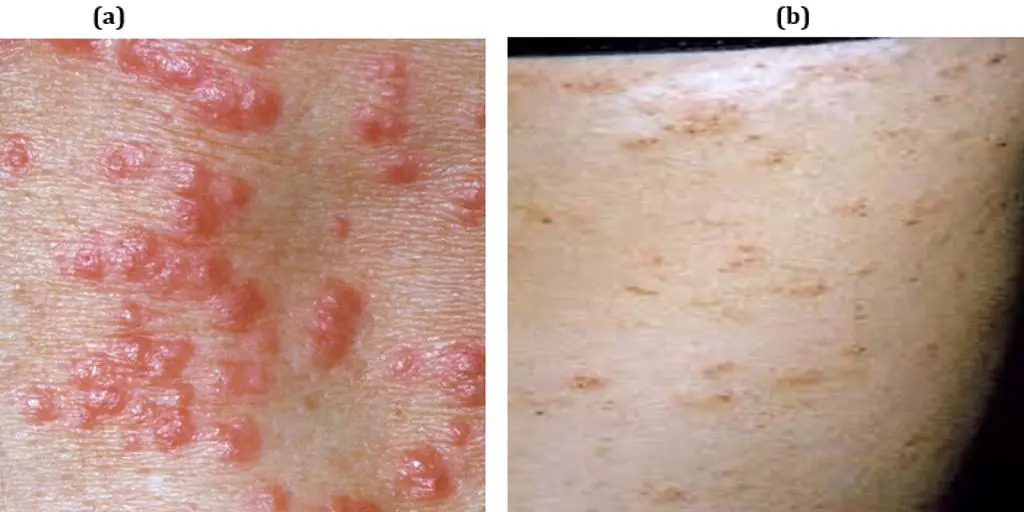 dog with scabies treatment
